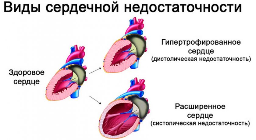 Виды сердечной недостаточности