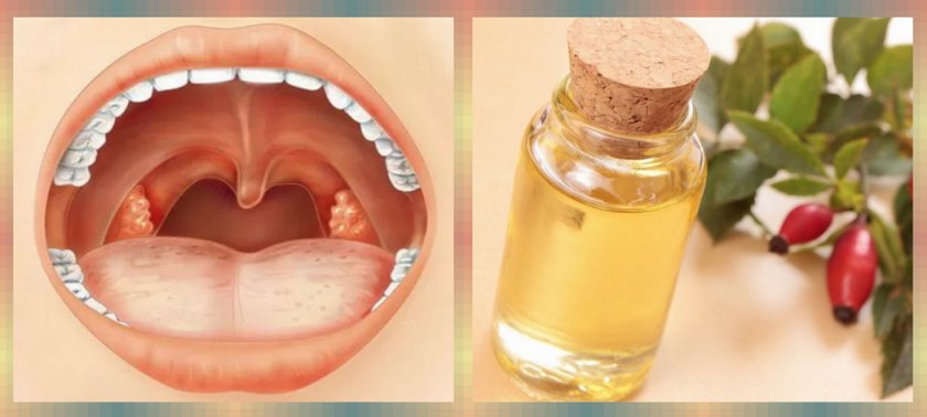 Масло шиповника при фарингите Масло шиповника при фарингите