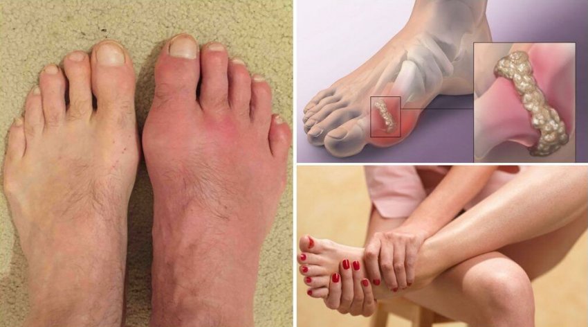 Журавлина при подагрі