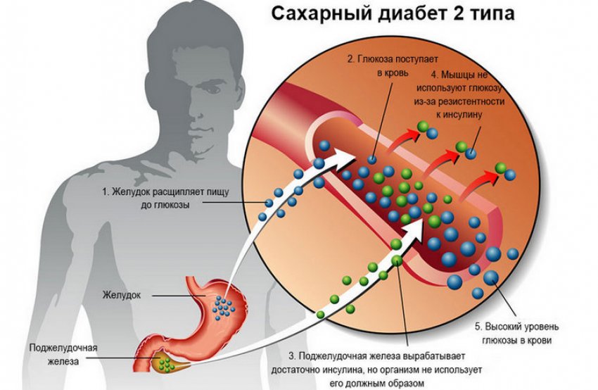 Цукровий діабет другого типу