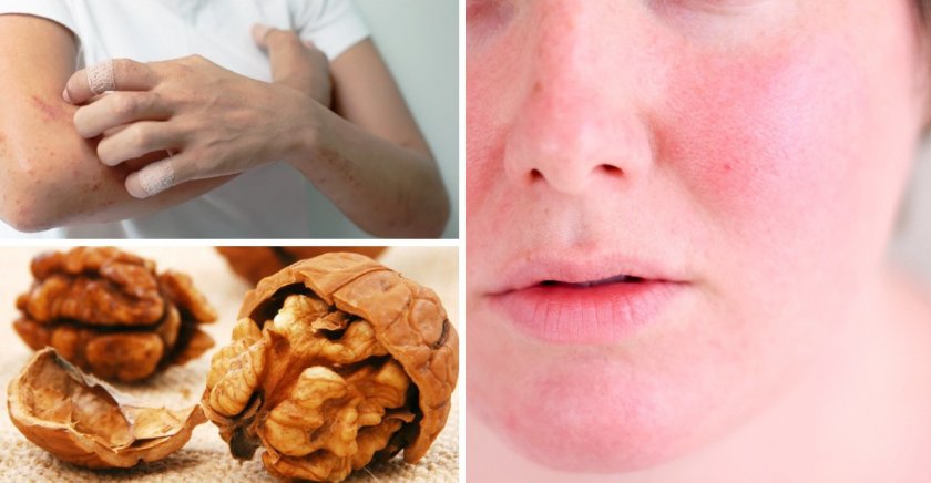 Аллергия на грецкие орехи у взрослых