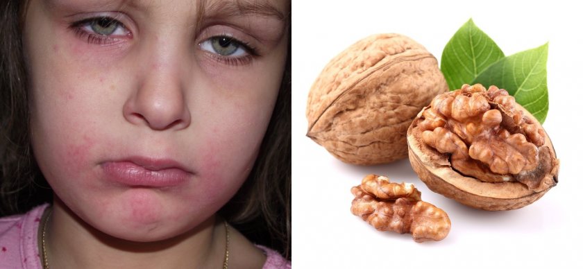 Аллергия на грецкие орехи у ребёнка