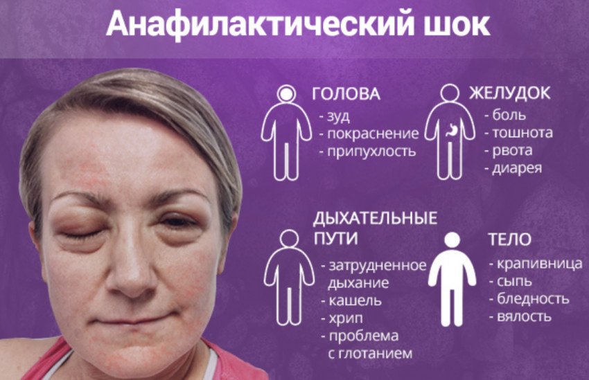 Симптоми анафілактичного шоку