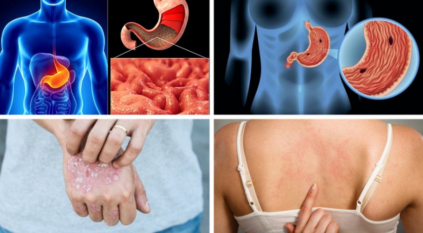 Протипоказання до вживання Протипоказання до вживання