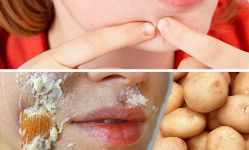 Маска на основі картоплі від прищів