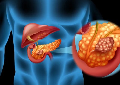 Чи можна вживати волоські горіхи при панкреатиті