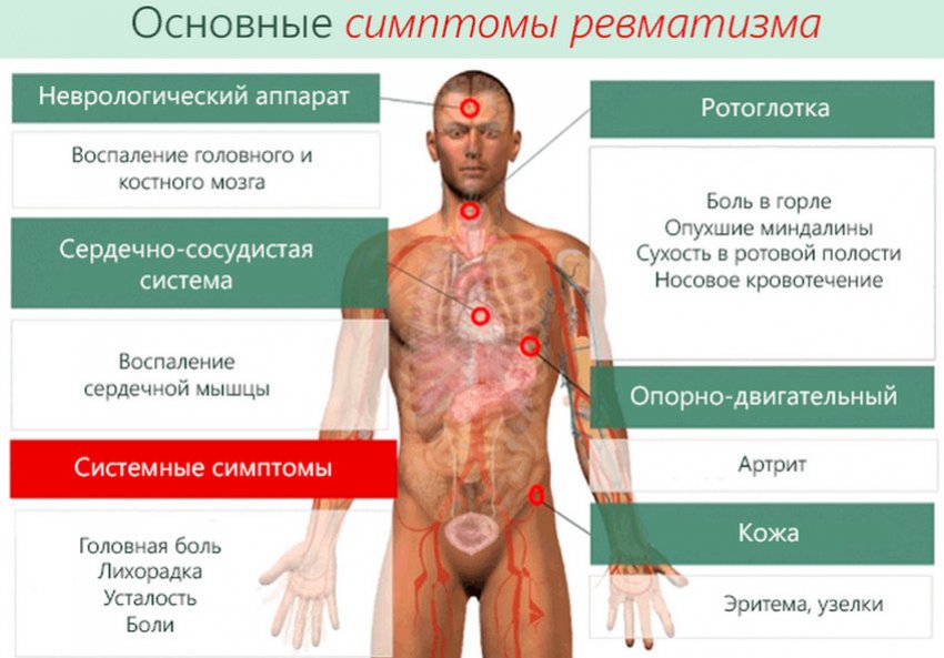 Симптоми ревматизму Симптоми ревматизму