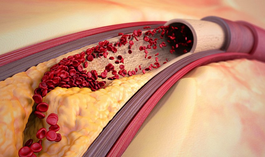 Атеросклероз сосудов
