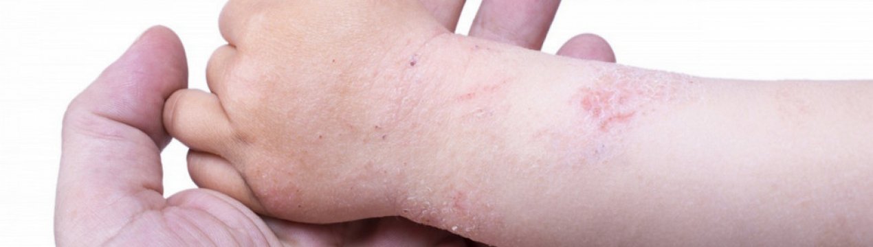 Обліпихова олія при дерматиті