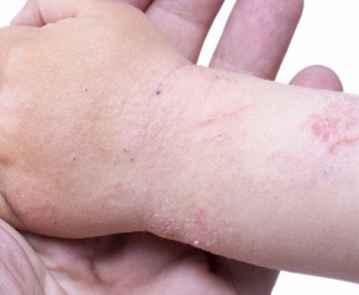 Обліпихова олія при дерматиті