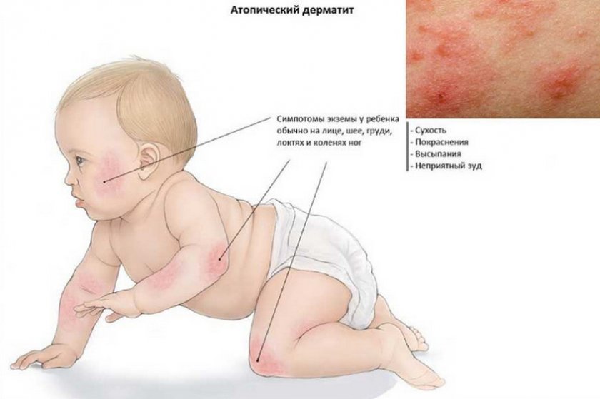 Атопический дерматит у грудничков облепиховое масло thumbnail