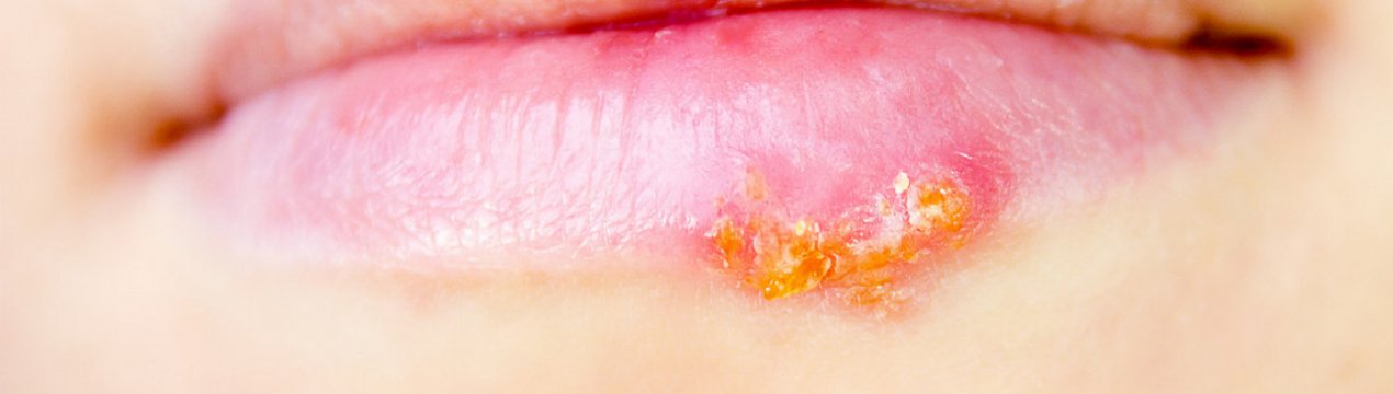 Обліпихова масло від герпесу