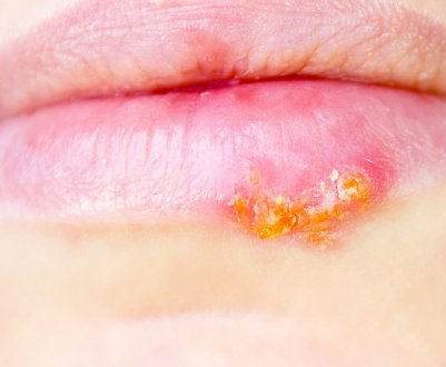 Обліпихова масло від герпесу