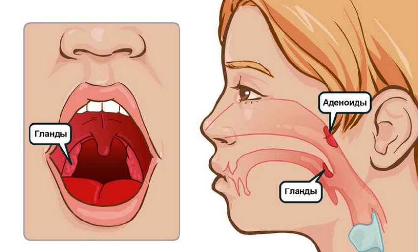 Аденоїди у дітей