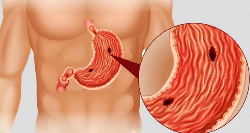 Виразка шлунка