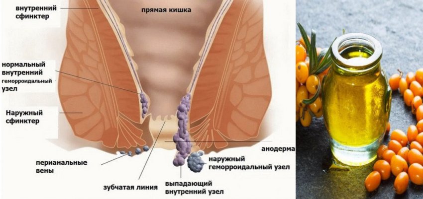 Обліпихова олія при геморої