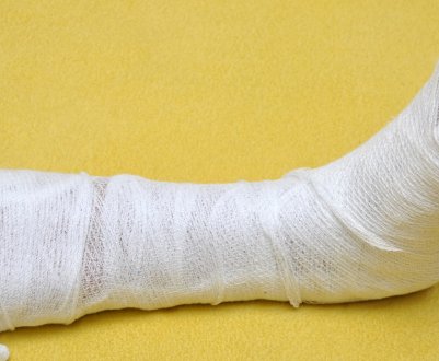 Застосування пихтового масла при переломах ніг