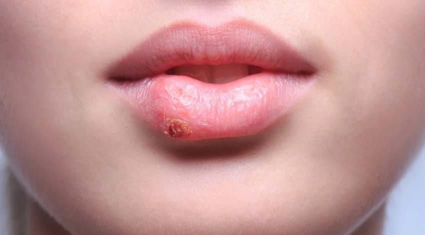 Ялицеве масло при герпес на губах