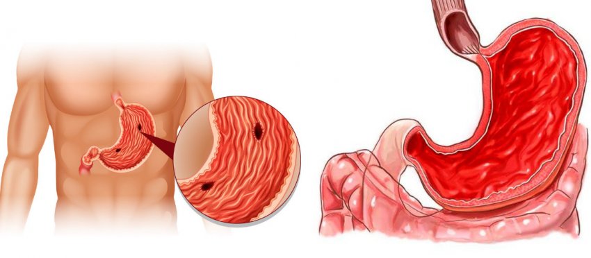 Протипоказання до вживання варення Протипоказання до вживання варення