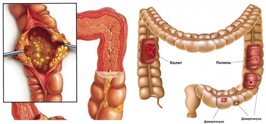 Облепиховое масло при колите