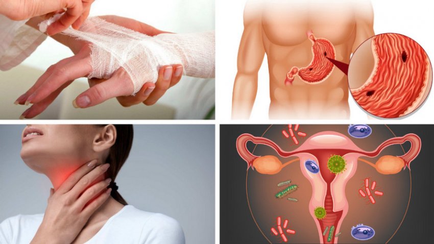 Застосування обліпихи в медицині Застосування обліпихи в медицині