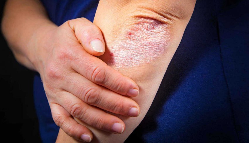 Незабудка проти екземи Незабудка проти екземи