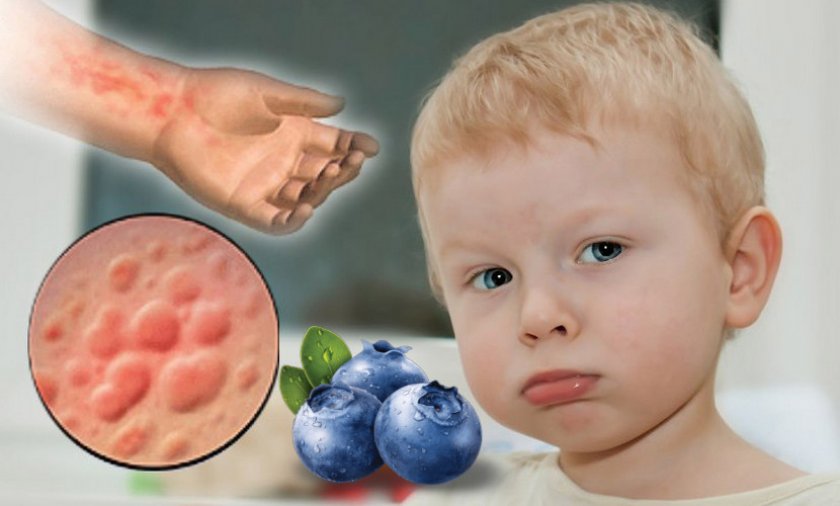 Аллергия на чернику у детей
