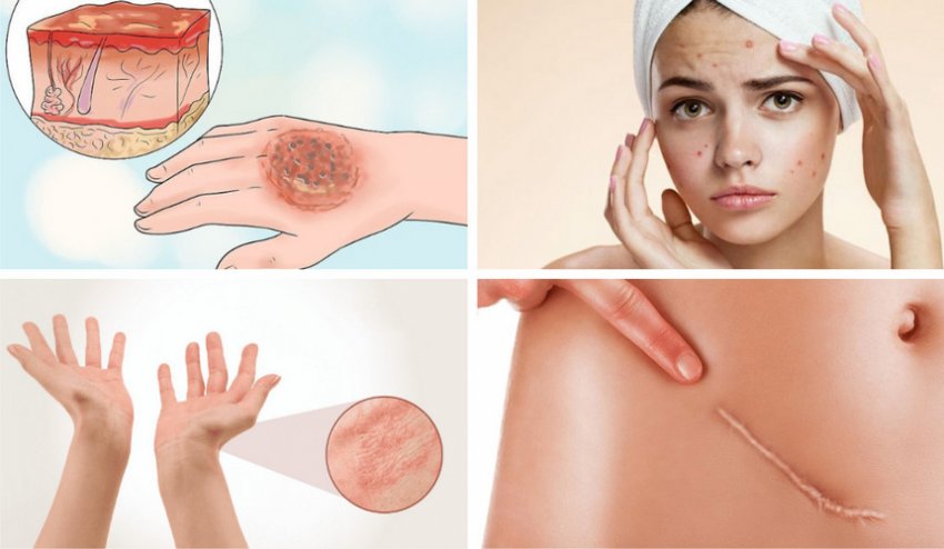 Показания к применению кедрового масла в косметологии Показания к применению кедрового масла в косметологии