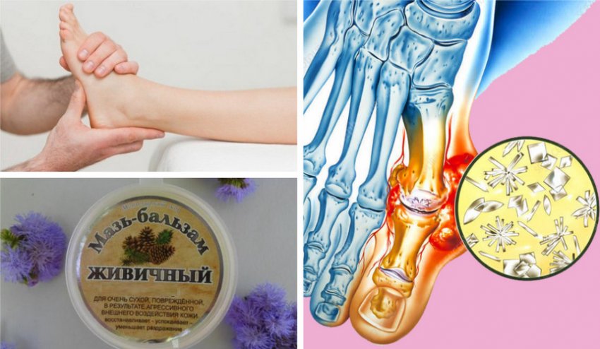 Масаж кедровим бальзамом при подагрі Масаж кедровим бальзамом при подагрі