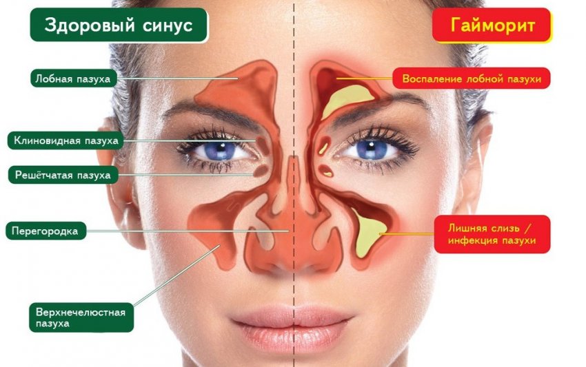 Гайморит Гайморит