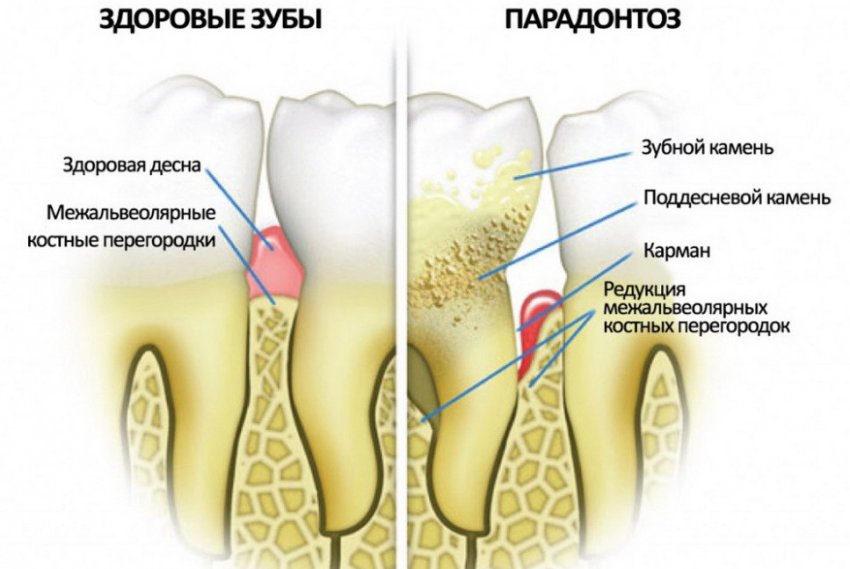 Кедрова живиця при пародонтозі Кедрова живиця при пародонтозі
