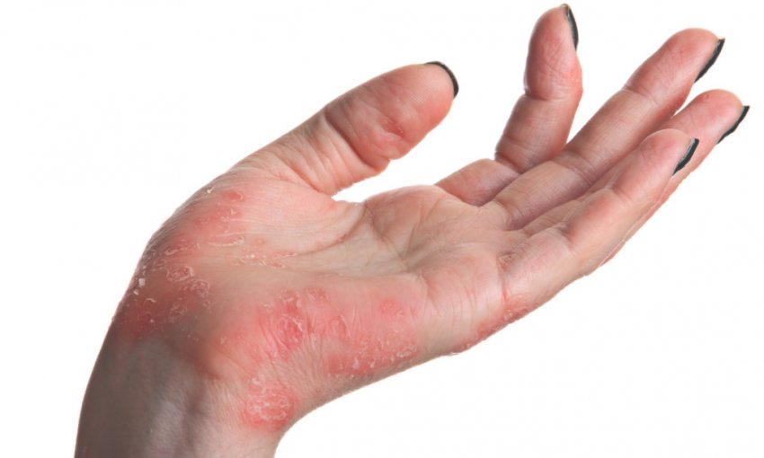 Живиця кедра при псоріазі Живиця кедра при псоріазі