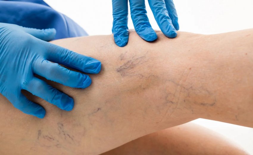 Варикозне розширення вен Варикозне розширення вен