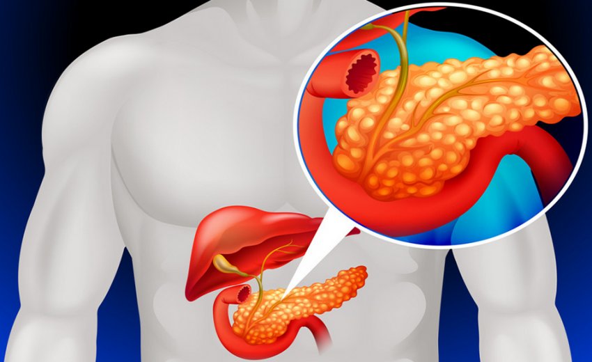 Панкреатит Панкреатит