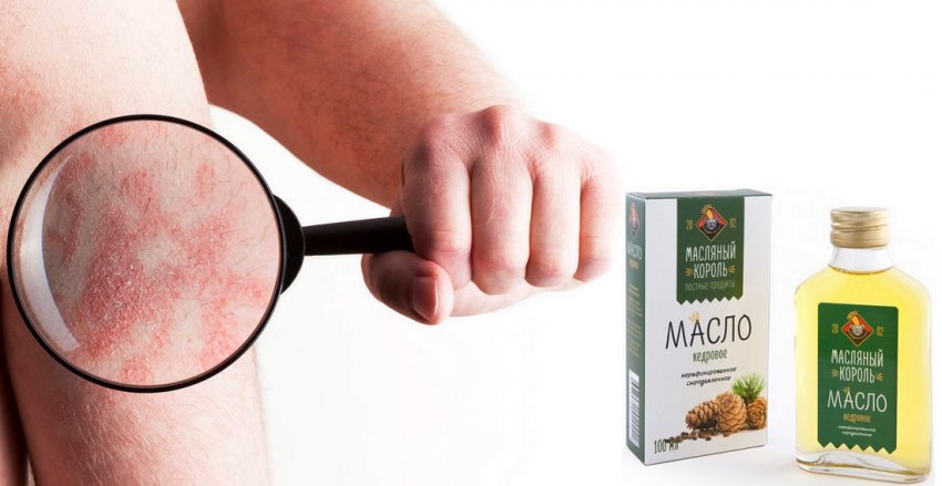 Псоріаз Псоріаз