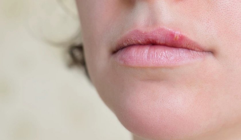 Герпес на губах