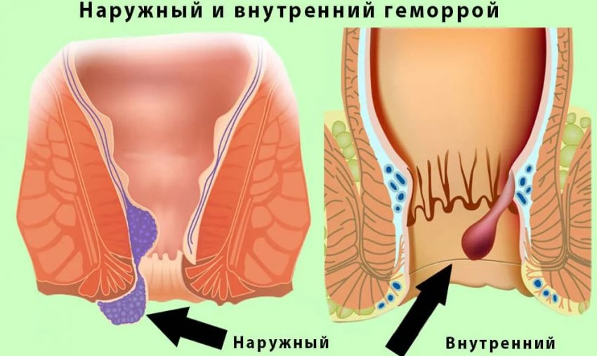 Купена лікарська для лікування геморою Купена лікарська для лікування геморою