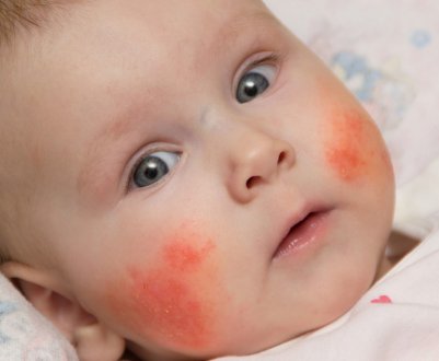 Алергія на гречку в немовляти