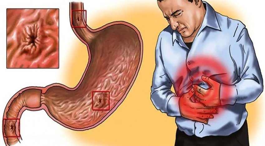 Гречка з кефіром при проблемах с ЖКТ