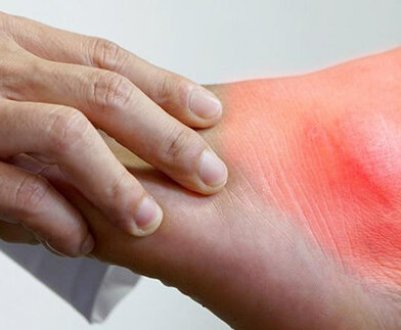 Особливості вживання гречки в разі подагри