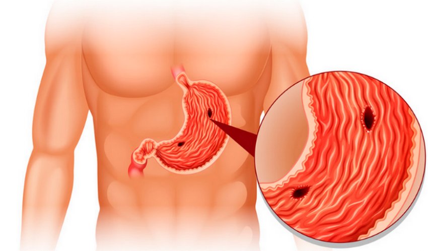 Вівсяна олія при лечении язвы ЖКТ Вівсяна олія при лечении язвы ЖКТ