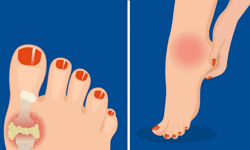 Захворювання подагра