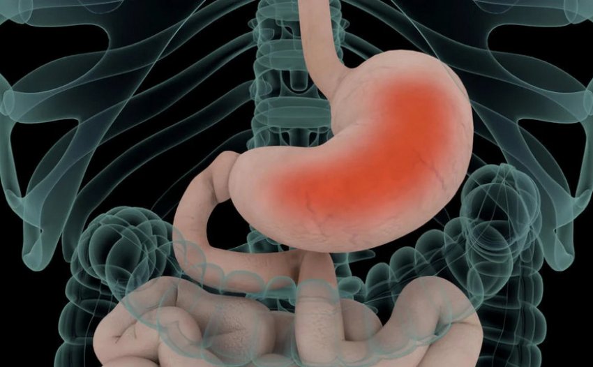 Захворювання гастрит