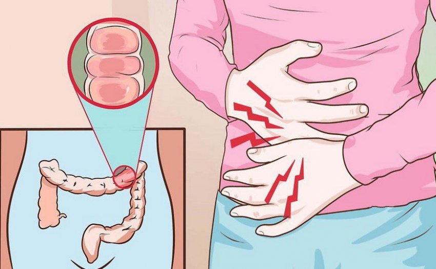 Захворювання коліт