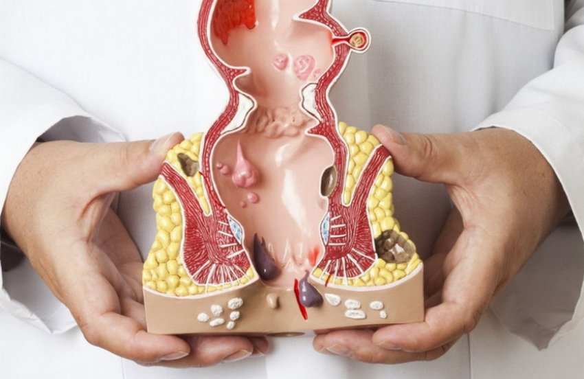 Захворювання геморой