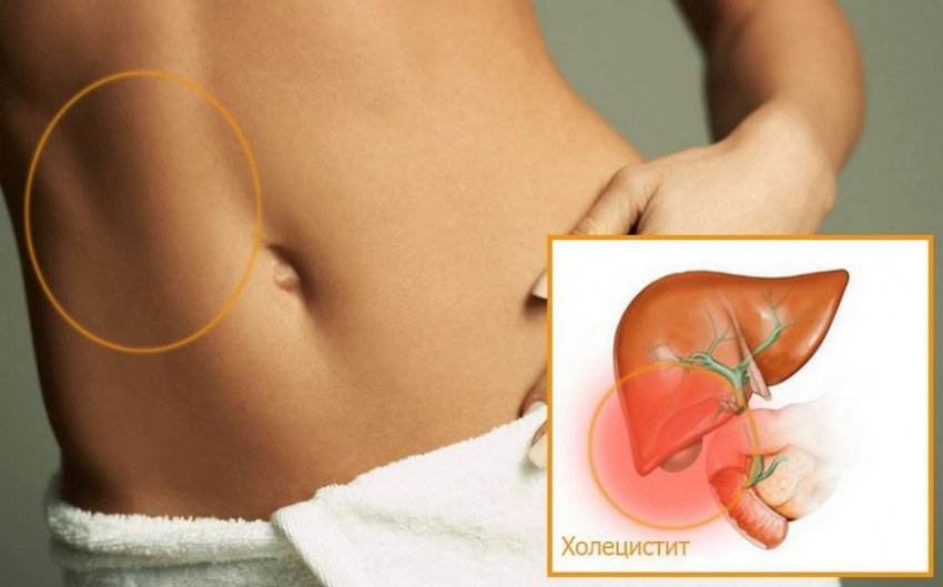 Захворювання холіцистит
