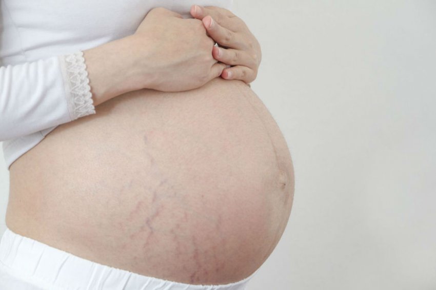 Розтяжки під час вагітності