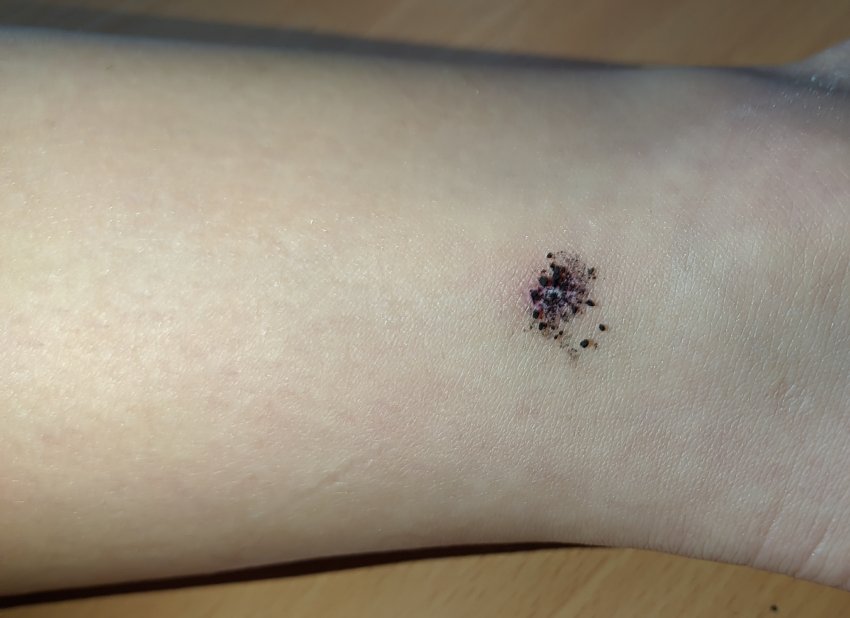 Активоване вугілля при порізах та укусах комах