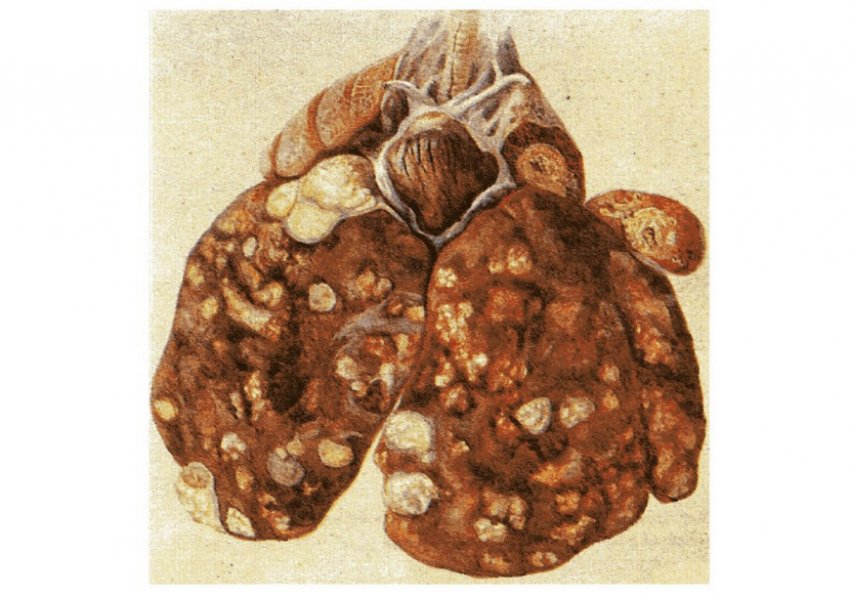 Туберкульоз печінки курки