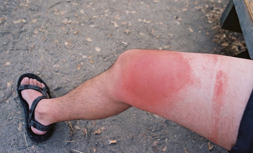 Симптоми укусу шершня